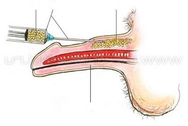 méadú bod instealladh