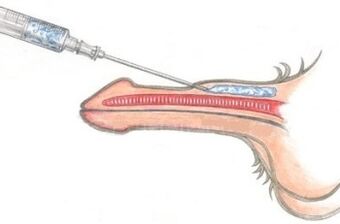 Modh contúirteach chun bod a mhéadú ag baint úsáide as instealltaí Vaseline